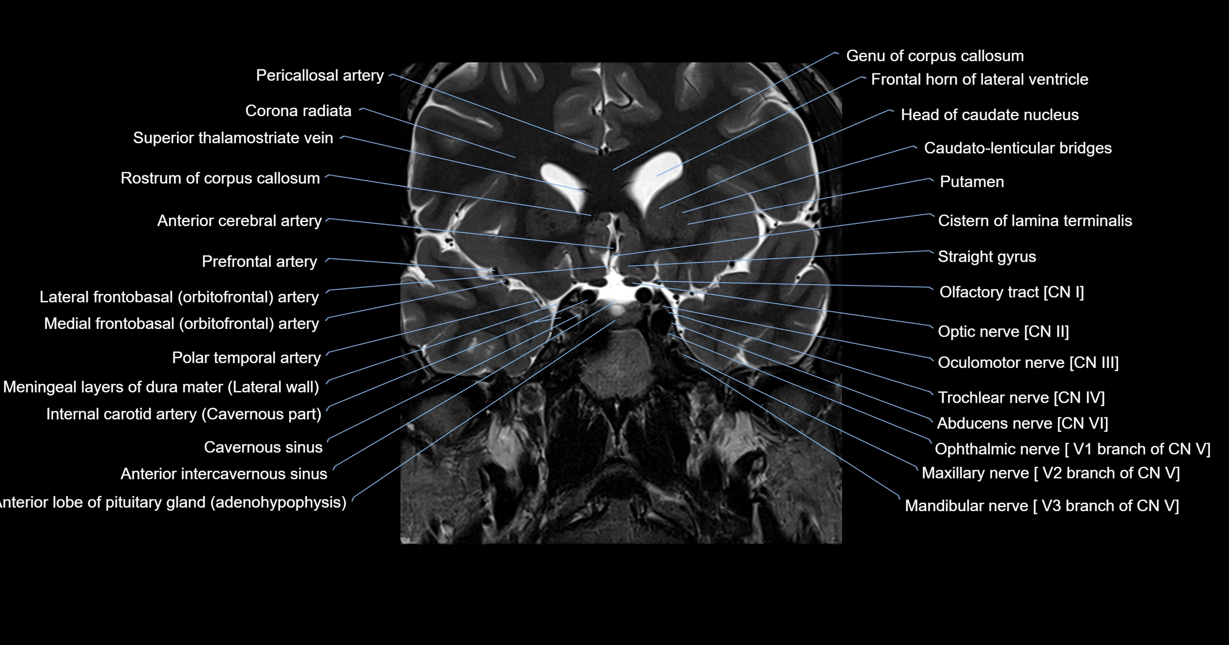 MRI brainstem & basal ganglia anatomy labelled 3T MRI images -img-00001-00009.webp